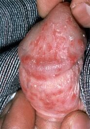 afscheiding uit de penis als gevolg van spruw